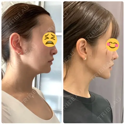 脂肪吸引（顔） / 輪郭修正 / ジョールファット除去 / 脂肪注入（輪郭） WOM CLINIC GINZA （ワム クリニック ギンザ） AFTER