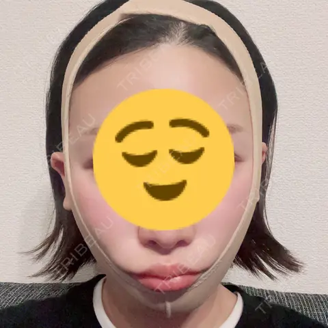 糸リフト / 脂肪吸引（顔） X CLINIC 銀座院 DAY 0