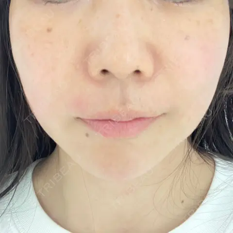 ハイフ（顔） TCB東京中央美容外科 岡山院 DAY 0