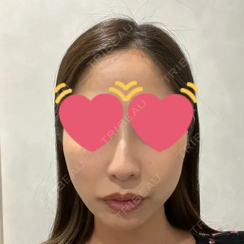 糸リフト YBC横浜美容外科 立川院 DAY 0