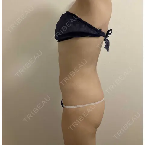 インディバ（お腹） Medical Indiba Salon KMK【脂肪吸引後ダウンタイム専門サロン】 AFTER