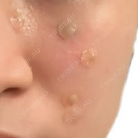 ほくろ・いぼ除去レーザー（肌） Fellez Clinic【フェルズクリニック】 DAY 0