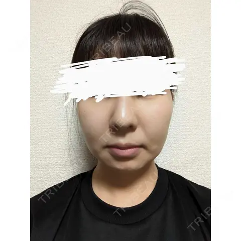 メーラーファット除去 WOM CLINIC GINZA （ワム クリニック ギンザ） AFTER