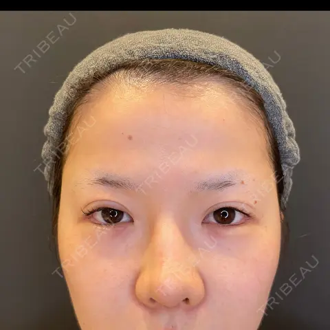目尻切開 / タレ目形成・グラマラスライン（埋没） / 美容点滴・美容注射（美肌） LOUIS CLINIC 二子玉川院【ルイクリニック】 DAY 0