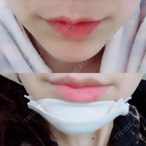 あごプロテーゼ ジュエリー美容外科 DAY 0