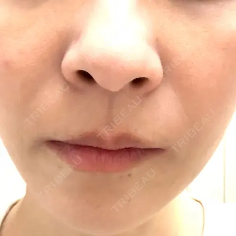 イオン導入 / ピコレーザートーニング（美白・肝斑） 湘南美容クリニック 静岡院 DAY 0