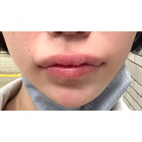 ボトックス（人中） YBC横浜美容外科 立川院 AFTER