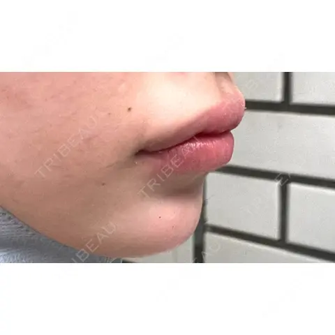 ボトックス（人中） YBC横浜美容外科 立川院 AFTER