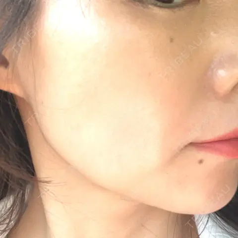 ハイフ（顔） TCB東京中央美容外科 岡山院 AFTER