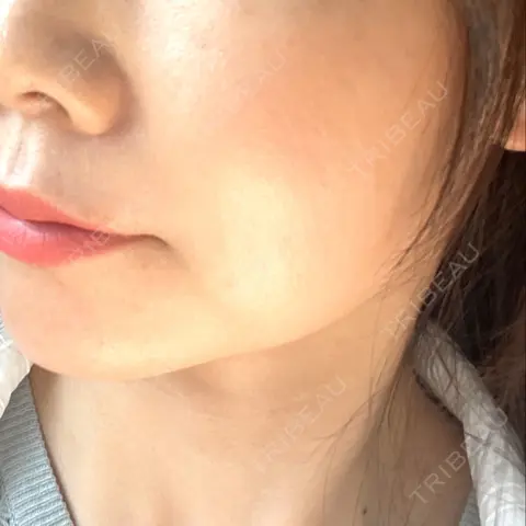 ハイフ（顔） TCB東京中央美容外科 岡山院 AFTER
