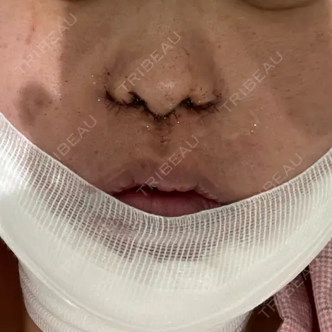 小鼻縮小（切開） / 鼻翼挙上 Otus Clinic 【オータスクリニック】 DAY 0