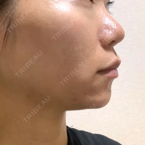 肌ヒアルロン酸注入（たるみ・シワ改善） / ヒアルロン酸注入（あご） シェリークリニック 福岡院 AFTER