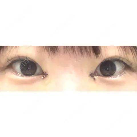 目頭切開 くさのたろうクリニック DAY 0