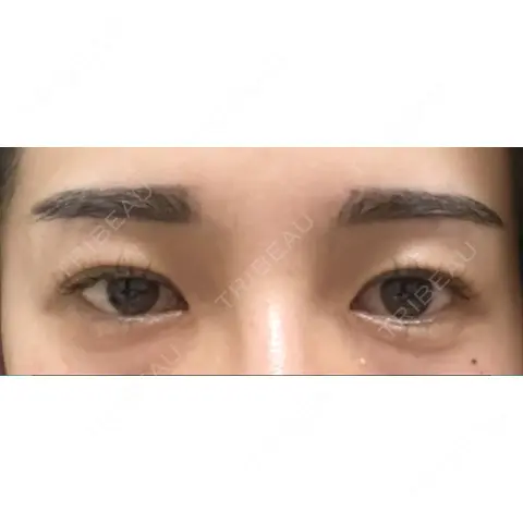 二重埋没 A CLINIC（エークリニック） 銀座院 AFTER