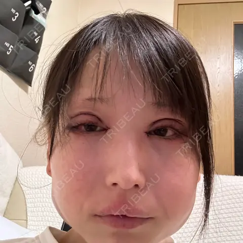 二重切開 / 目頭切開 / 目尻切開 / 下まぶたの脂肪取り / ヒアルロン酸注入（目の下） 湘南美容クリニック 岐阜院 DAY 0