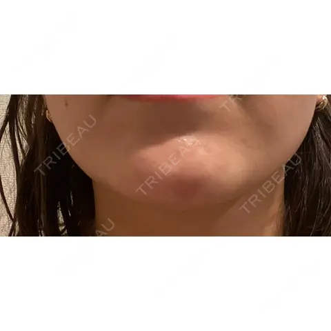 ヒアルロン酸注入（あご） 麻布十番クレールデンタルクリニック AFTER
