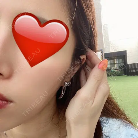 PRP皮膚再生療法 EMMO FACE CLINIC 大宮院 AFTER