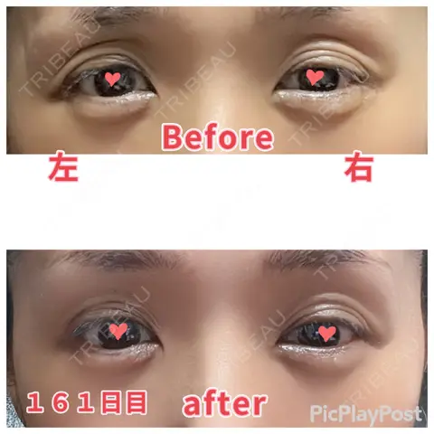 二重切開 / 眼瞼下垂（切開） / 上まぶたたるみ取り 心斎橋形成外科スキンケアクリニック AFTER