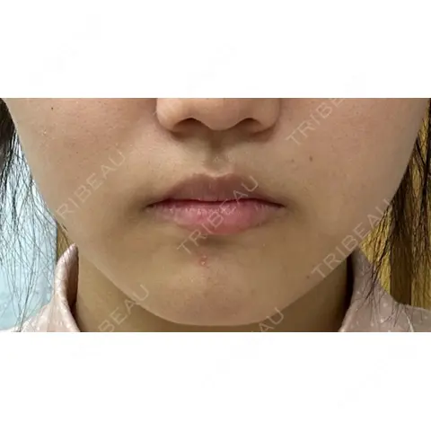 ボトックス（エラ・小顔） KAGA CLINIC AFTER