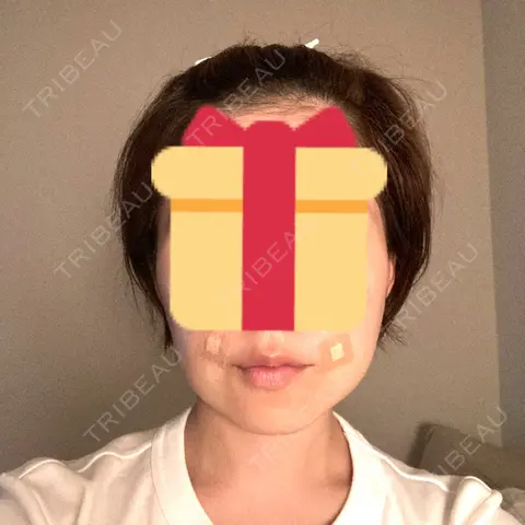 脂肪溶解注射（顔） 東京ロイヤルクリニック DAY 0