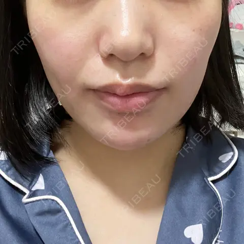 糸リフト / バッカルファット除去 / 脂肪吸引（顔） 湘南美容クリニック 京都院 AFTER