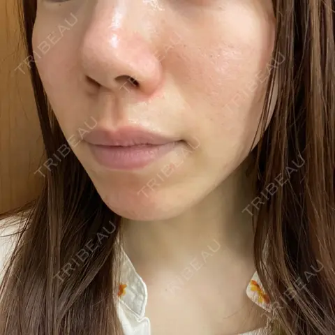 ヴェルヴェットスキン KOBE美容皮膚科 神戸東灘院 AFTER