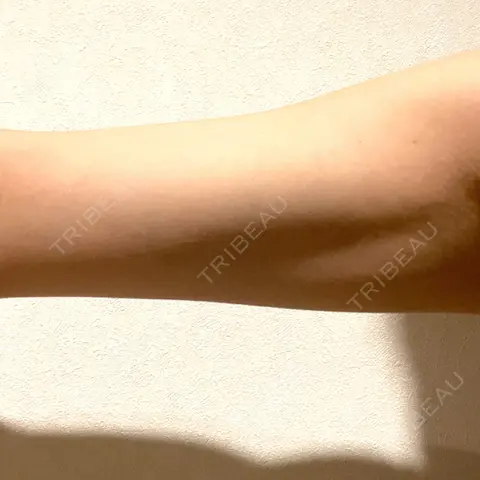 脂肪溶解注射 / その他 HAAB BEAUTY CLINIC 名古屋院 AFTER