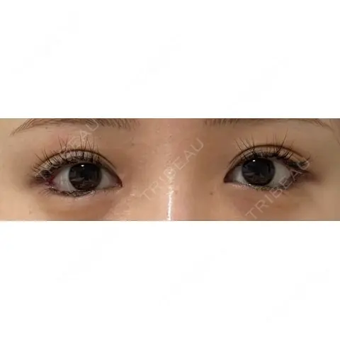 目尻切開 / タレ目形成・グラマラスライン（埋没） LOUIS CLINIC 二子玉川院【ルイクリニック】 AFTER