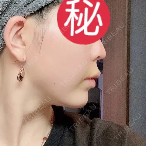 糸リフト / 人中短縮 / ボトックス（あご） / ヒアルロン酸注入（唇） / ボトックス（口角） / ボトックス（人中） EMMO FACE CLINIC 大宮院 AFTER