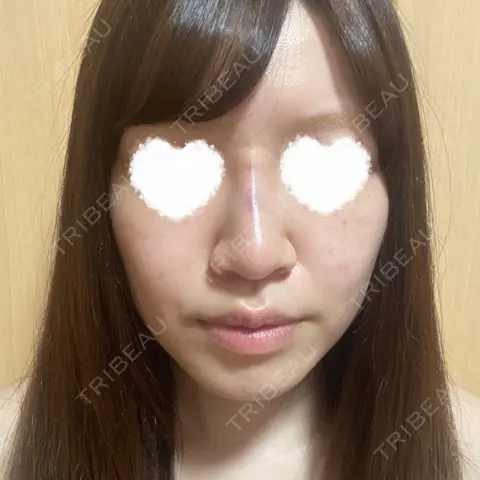 ヒアルロン酸注入（鼻） アクトリー勝どきウェルネスメディカルクリニック DAY 0