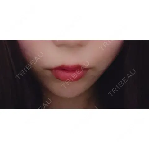 ヒアルロン酸注入（あご） / ボトックス（エラ・小顔） / ヒアルロン酸注入（唇） TCB東京中央美容外科 郡山院 DAY 0