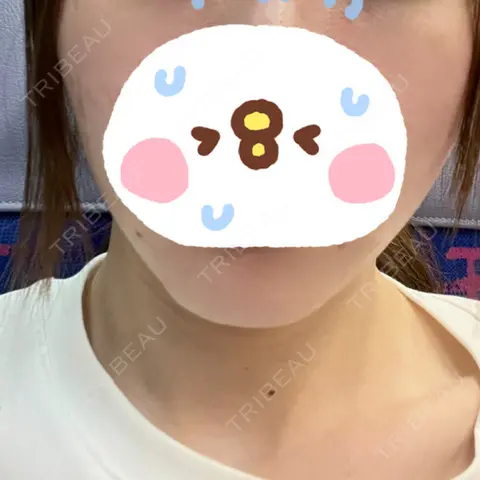 ハイフ（顔） あおばクリニック 名古屋栄院 DAY 0