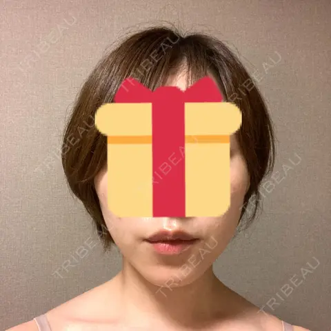 脂肪溶解注射（顔） 東京ロイヤルクリニック AFTER