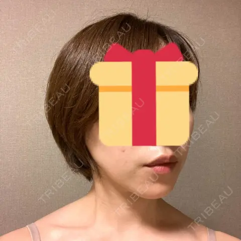 脂肪溶解注射（顔） 東京ロイヤルクリニック AFTER
