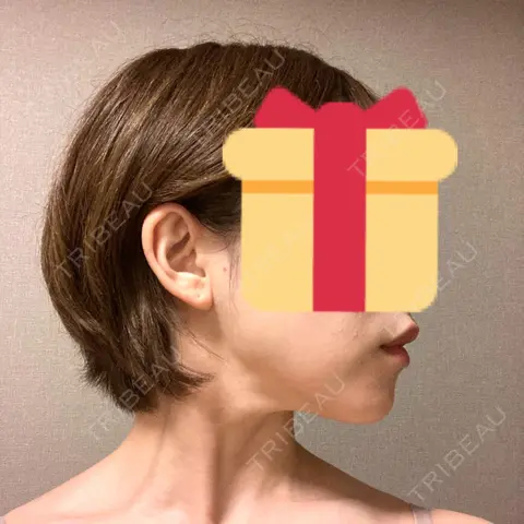 脂肪溶解注射（顔） 東京ロイヤルクリニック AFTER