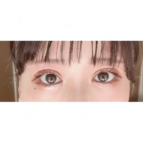 二重切開 / 目頭切開 / 目尻切開 / 下まぶたの脂肪取り / ヒアルロン酸注入（目の下） 湘南美容クリニック 岐阜院 AFTER