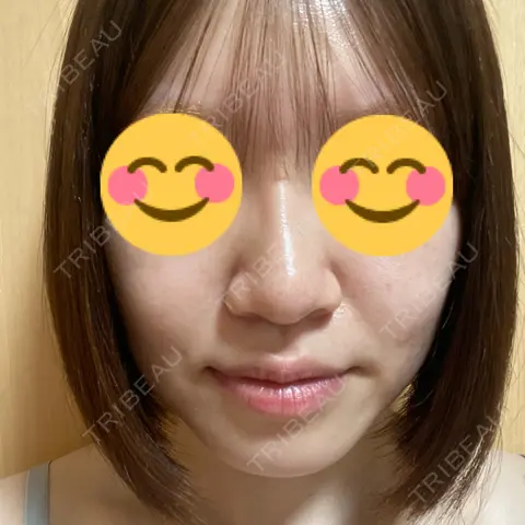 ヒアルロン酸注入（鼻） アクトリー勝どきウェルネスメディカルクリニック AFTER