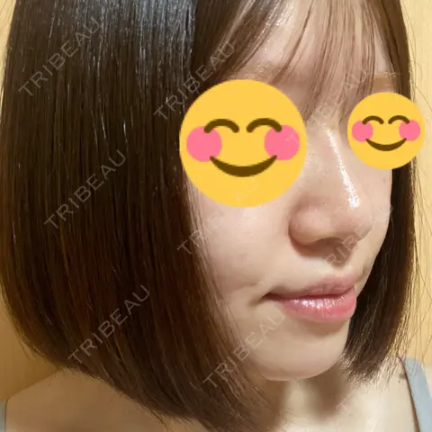 ヒアルロン酸注入（鼻） アクトリー勝どきウェルネスメディカルクリニック AFTER