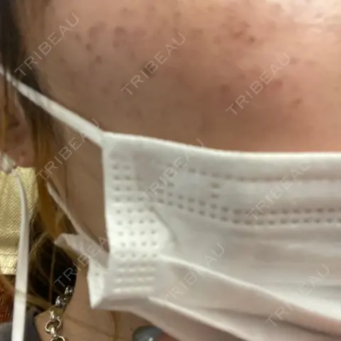 シミ取りレーザー Olino美容外科・美容皮膚科 DAY 1