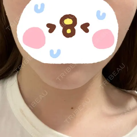 ハイフ（顔） あおばクリニック 名古屋栄院 AFTER