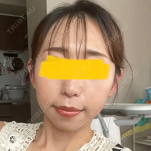 小鼻縮小（切開） / 鼻翼挙上 Otus Clinic 【オータスクリニック】 AFTER