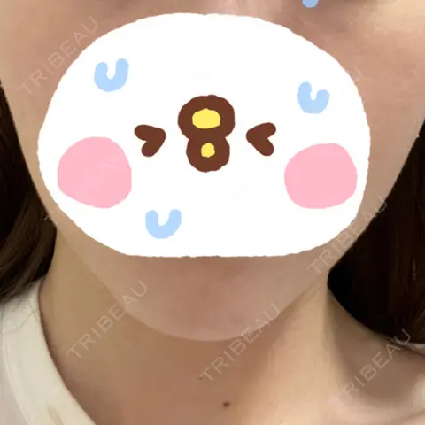 ハイフ（顔） あおばクリニック 名古屋栄院 AFTER