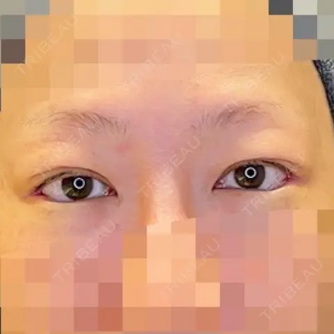 目尻切開 / タレ目形成・グラマラスライン（埋没） LOUIS CLINIC 二子玉川院【ルイクリニック】 DAY 0