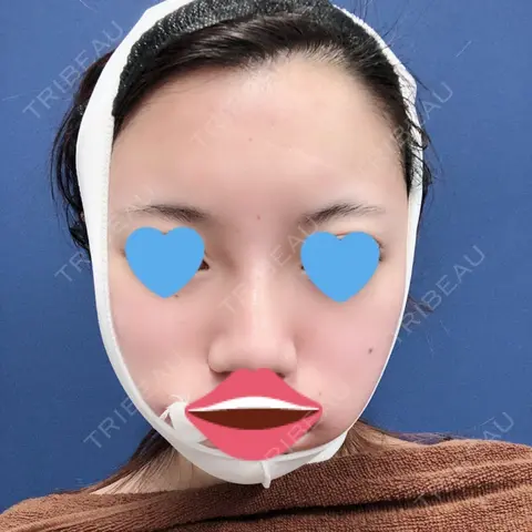バッカルファット除去 / 脂肪吸引（顔） / ヒアルロン酸注入（鼻） 湘南美容クリニック 横浜東口院 DAY 0