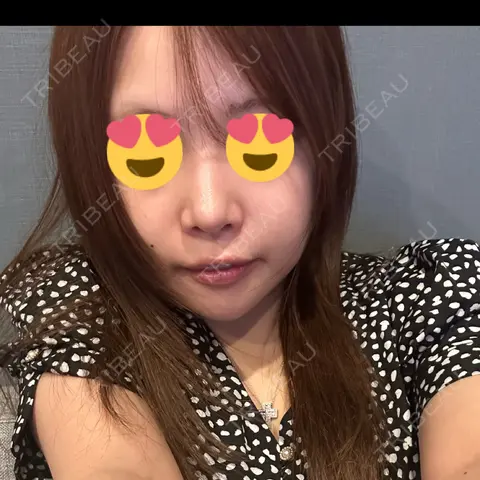 隆鼻術 / 鼻尖形成（切開） / 鼻中隔延長（切開） / 骨切幅寄せ / 脂肪注入（額） THE ROPPONGI CLINIC（ザ 六本木クリニック） AFTER