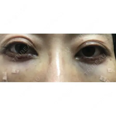 クマ治療 / 下まぶたたるみ取り / 脂肪注入（目の下） 湘南美容クリニック Regno 銀座院 DAY 0