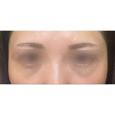クマ治療 HAAB×DREAM BEAUTY CLINIC 大阪梅田院 DAY 0