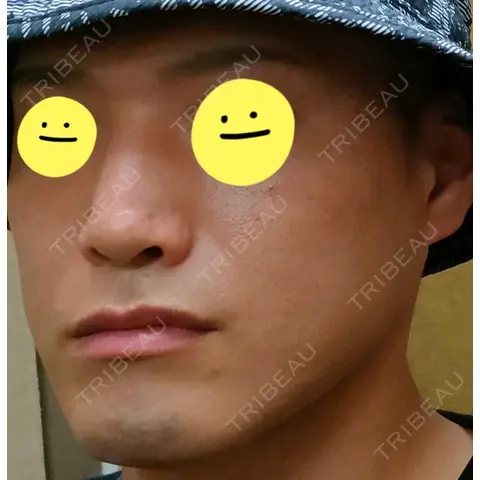 シミ取りレーザー Olino美容外科・美容皮膚科 AFTER