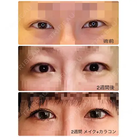 目尻切開 / タレ目形成・グラマラスライン（埋没） LOUIS CLINIC 二子玉川院【ルイクリニック】 AFTER