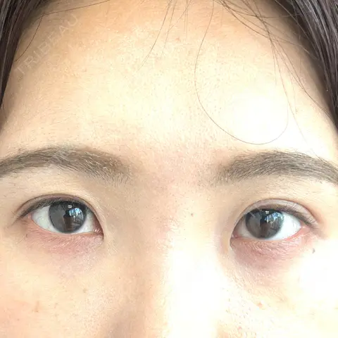 二重埋没 BLINC CLINIC （ブリンク クリニック） AFTER